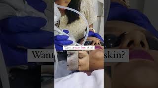 Acne Scar Treatment  Welona Clinic Chennai [upl. by Pogue137]