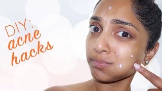 How to Get Rid of Acne with Egg Whites  Deepica Mutyala [upl. by Feldstein]