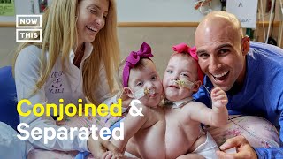 Conjoined Twins Separated After Successful Surgery [upl. by Kcirdneh]