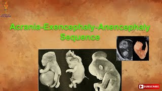 AcraniaExencephalyAnencephaly Sequence [upl. by Maribel]