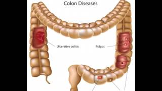 What is Bifidobacterium Infantis [upl. by Belen]