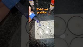 Serological practical WIDAL test typhoidfever trending practical pathology shorts [upl. by Rillis]