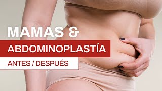 ¿Qué es una abdominoplastia [upl. by Ahsenhoj]