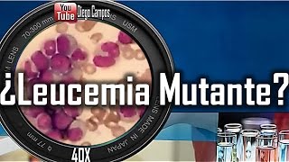 Caso clinico Nº1 Leucemia mieloide CronicaLMC [upl. by Kragh]