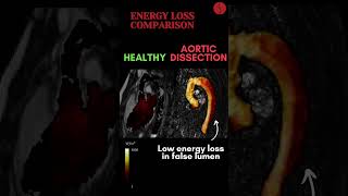 Aortic Dissection EnergyLoss [upl. by Housen]