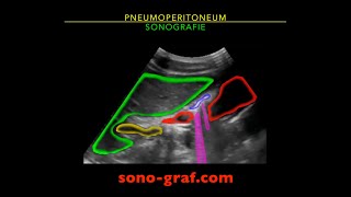 Sonographie  Pneumoperitoneum [upl. by Rutan492]