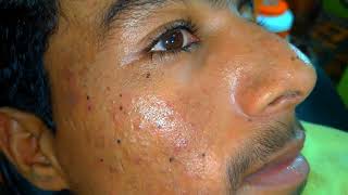 sac be spa blackheads elderly 2024  sac be spa old age blackheads 2024  sac be spa thuy 965 [upl. by Ajnin385]