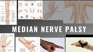 Median Nerve palsy  Anatomy CausesClinical featuresDeformity Special test Pt management [upl. by Ecargyram]