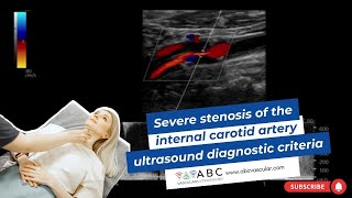 Severe stenosis of the internal carotid artery ultrasound diagnostic criteria [upl. by Noraed]