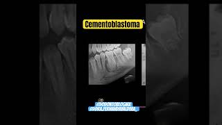 Cementoblastoma shorts patologiabucal cementoblastoma odontologia radiologiadental [upl. by Elehcim]