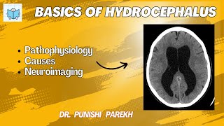 Basics of hydrocephalus [upl. by Benjamen]