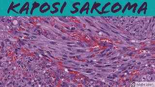 Kaposi Sarcoma 5Minute Pathology Pearls [upl. by Ainnos501]