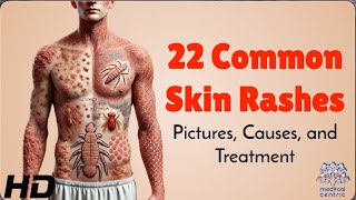 22 Skin Rashes Everyone Should Know About Symptoms amp Treatments [upl. by Ueik]