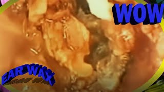 How To removal earwax at home with hydrogen peroxide ear wax removal Spa EP151 [upl. by Efar]