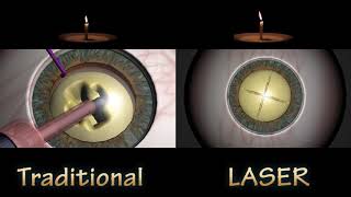 FLACS VS TRADITIONAL CATARACT SURGERY  Nucleus Removal Compare [upl. by Carrol]