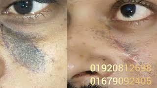 birthmark remove before after client review Bangladesh জন্ম দাগ রিমুভ এর বিফোর আফটার ক্লাইন্ট রিভিউ [upl. by Eseerahs]