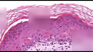 Erythema Multiforme Dermatopathology Easy learning [upl. by Ledda]