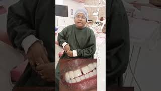 Front tooth gap filling  midline diastema treatment Dr Stellas Gracia dental clinic 9842744812 [upl. by Ihcelek854]