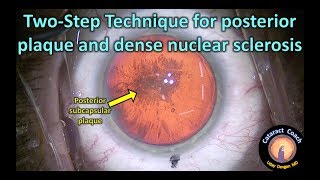 two step technique for cataract surgery with a posterior plaque and dense nucleus [upl. by Haughay619]