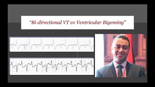 ECG Tip 24 BDVT vs VB [upl. by Atihana]