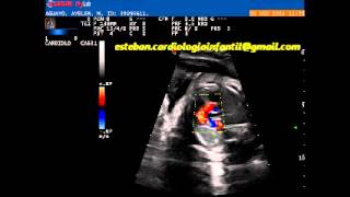 Ecocardiograma fetal Cardiopatía Congénita APSI [upl. by Saxen906]