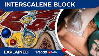 UltrasoundGuided Continuous Interscalene Brachial Plexus Block  Regional Anesthesia [upl. by Feenah]