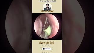 귀지형 콧물 부비동염 축농증 비염 코청소 이비인후과 rhinorrhea rhinitis sinusitis ASMR [upl. by Nickolas255]