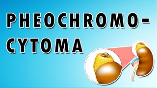 Pheochromocytoma Symptoms Treatment and Causes [upl. by Eliott]