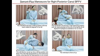 SemontPlus Manoeuvre for Right Posterior Canal BPPV [upl. by Ayatan]