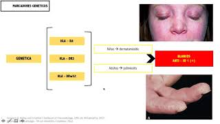 POLIMIOSITIS Y DERMATOMIOSITIS [upl. by Sollie]