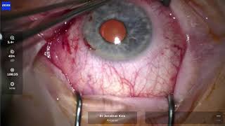 Pterygium Removal Surgery [upl. by Ahsetan]