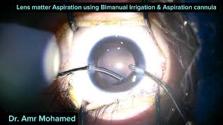 congenital cataract surgery [upl. by Andri]