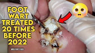 BIGGEST FOOT WART EVER TREATED 20 TIMES BEFORE  BY MISS FOOT FIXER [upl. by Trinee696]