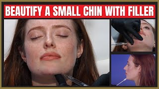 Enhance a Small Chin With Filler  Chin Filler Tutorial [upl. by Acnairb]