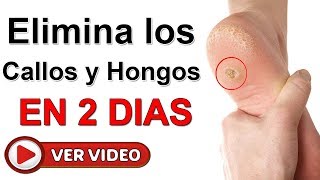 Elimina Callos Y Hongos De Los Pies En Solo 2 Días con este remedio casero de 2 ingredientes [upl. by Llig]