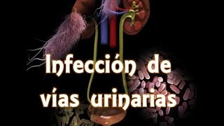 Infección de vías urinarias IVU [upl. by Nojed721]