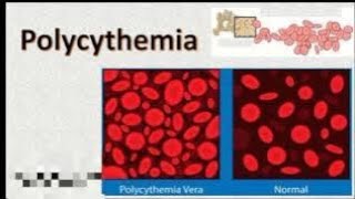 Polycythemia Definition of polycythemiaTypes of polycythemia💯💯 [upl. by Aikyt]