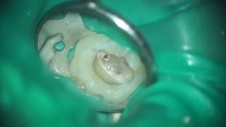 Pulpotomy with MTA [upl. by Ivens]