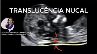 TRANSLUCÊNCIA NUCAL  Ultrassom obstétrico [upl. by Enirehtacyram]