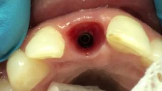 Provisional anterior duplicating the emergence profile [upl. by Savitt]