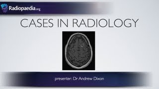 Cases in Radiology Episode 1 neuroradiology CT MRI [upl. by Salomo]