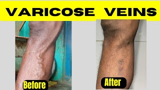 Laser treatment of varicose veins Diode laser ablation of varicose veins Varicose veins treatment [upl. by Ferdinanda]