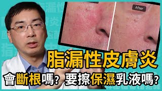 脂漏性皮膚炎會斷根嗎？需擦保濕乳液嗎？皮膚科林政賢醫師完整保養教學一次告訴你！ [upl. by Wymore]