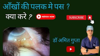 आँख की पलकों मे पस  Meibomitis eyecare Video258 [upl. by Cynthea534]