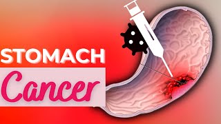 Stomach Cancer Causes Signs and Symptoms Diagnosis and Treatment [upl. by Ajak]