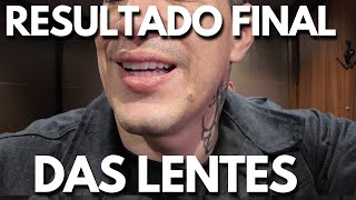 Como ficaram as minhas lentes de ZINCRONIO [upl. by Clair]