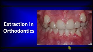 Extraction in Orthodontics [upl. by Gonagle858]