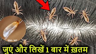 सर की जुएं liceऔर लिखें Nits 1 बार में ख़तम  बालों के लिए  Head Lice amp Nits Removal at home [upl. by Valeda]