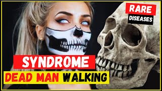 Cotards syndromesyndrome dead walking what is symptoms causes and treatment  Most rare disease [upl. by Fanning]