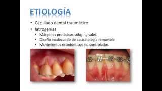 Clasificación de Recesiones Gingivales [upl. by Aisylla]